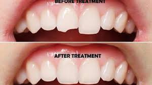 Teeth Reshaping