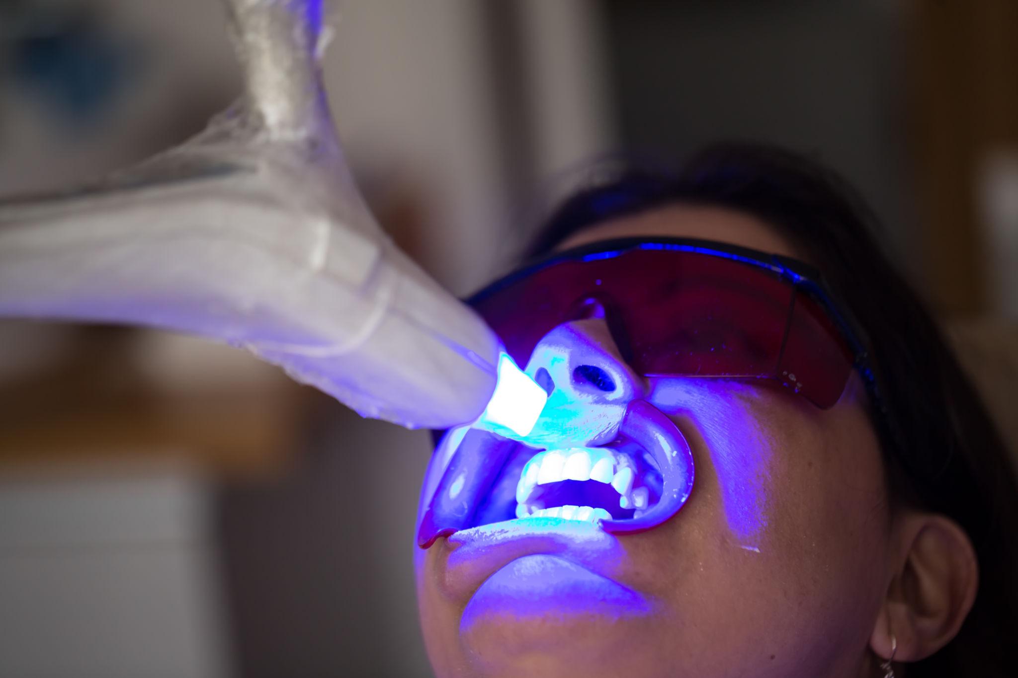 Teeth Whitening Treatment